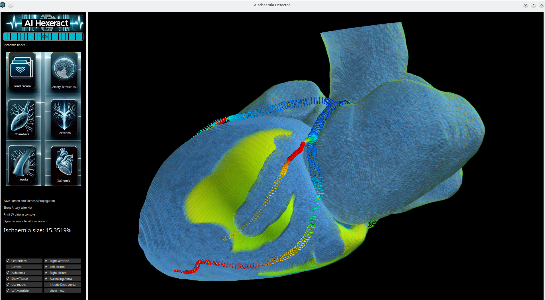 Desktop version – Ischaemia